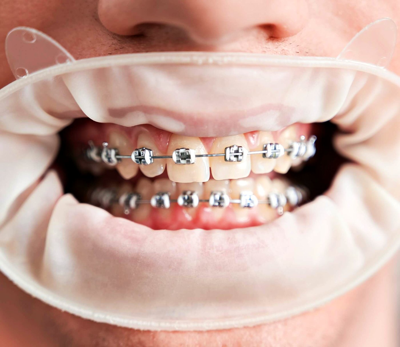 Braces being checked